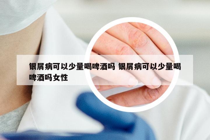 银屑病可以少量喝啤酒吗 银屑病可以少量喝啤酒吗女性