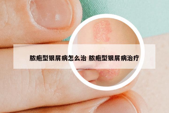 脓疱型银屑病怎么治 脓疱型银屑病治疗