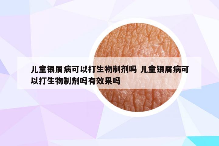 儿童银屑病可以打生物制剂吗 儿童银屑病可以打生物制剂吗有效果吗