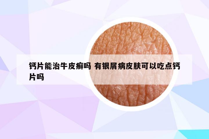 钙片能治牛皮癣吗 有银屑病皮肤可以吃点钙片吗