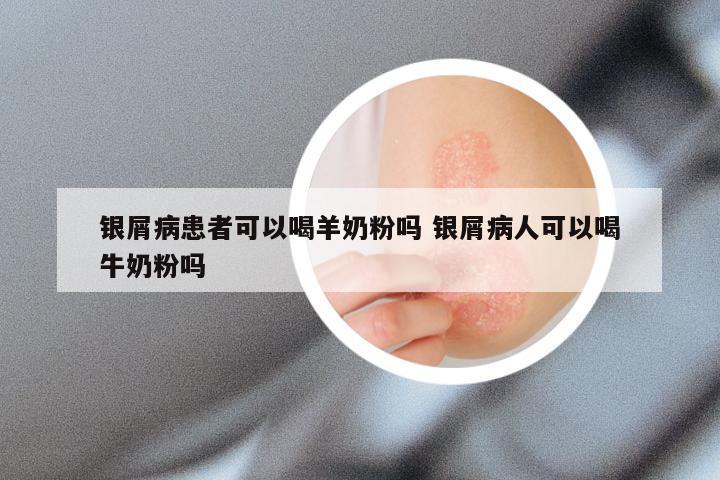 银屑病患者可以喝羊奶粉吗 银屑病人可以喝牛奶粉吗