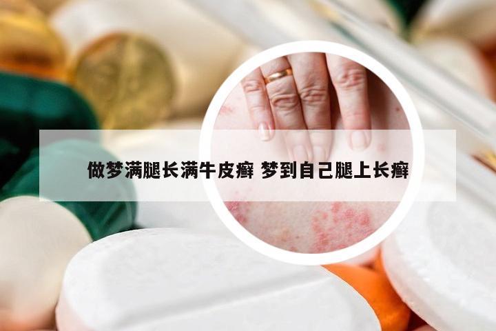 做梦满腿长满牛皮癣 梦到自己腿上长癣