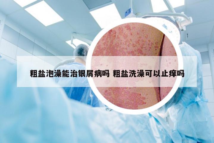 粗盐泡澡能治银屑病吗 粗盐洗澡可以止痒吗