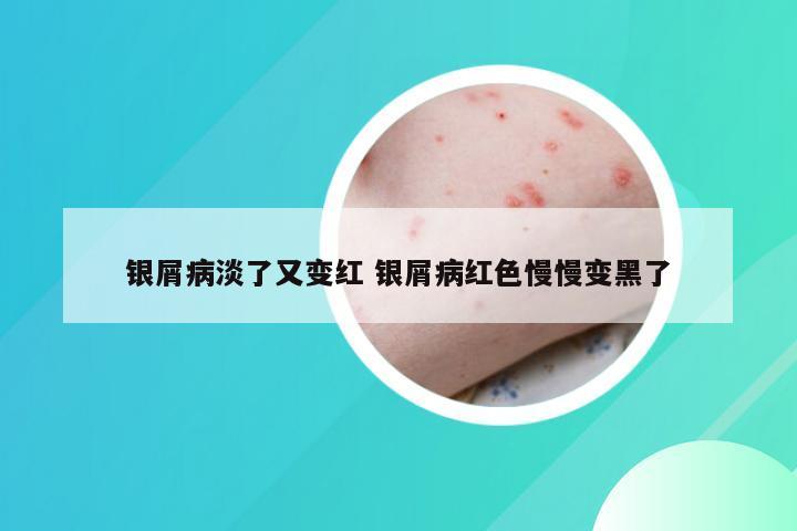 银屑病淡了又变红 银屑病红色慢慢变黑了