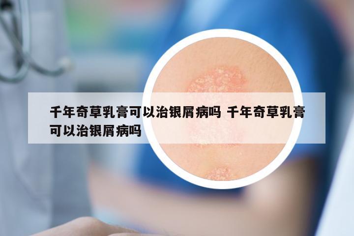 千年奇草乳膏可以治银屑病吗 千年奇草乳膏可以治银屑病吗