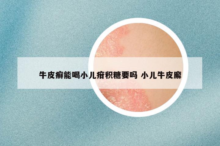 牛皮癣能喝小儿疳积糖要吗 小儿牛皮廨