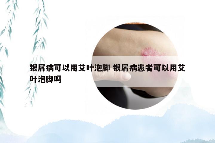 银屑病可以用艾叶泡脚 银屑病患者可以用艾叶泡脚吗