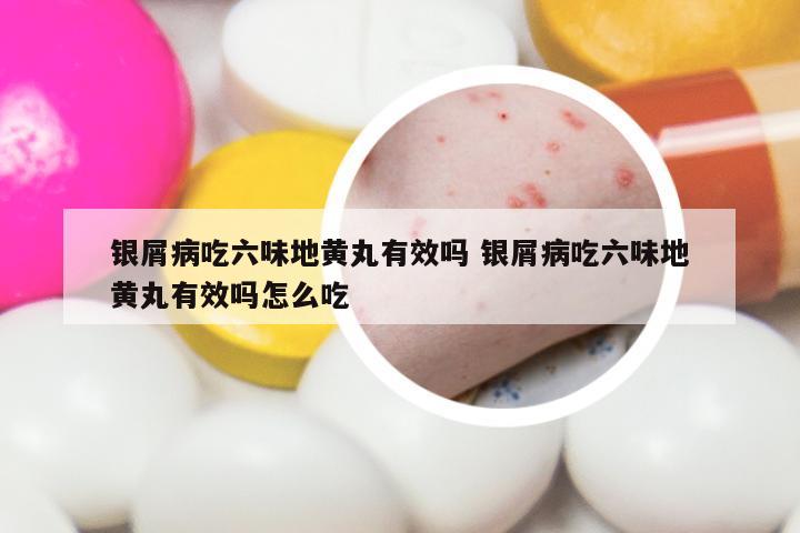 银屑病吃六味地黄丸有效吗 银屑病吃六味地黄丸有效吗怎么吃