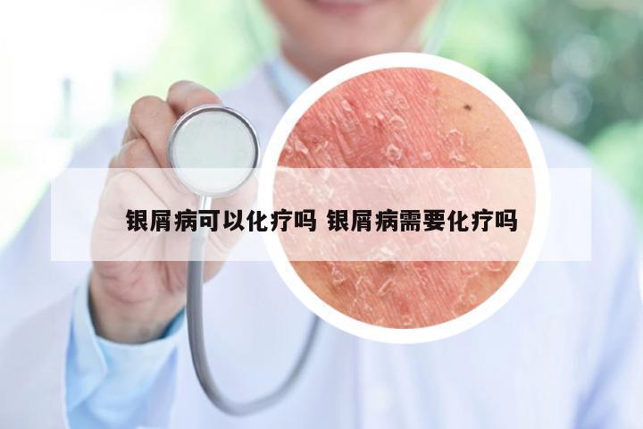 银屑病可以化疗吗 银屑病需要化疗吗