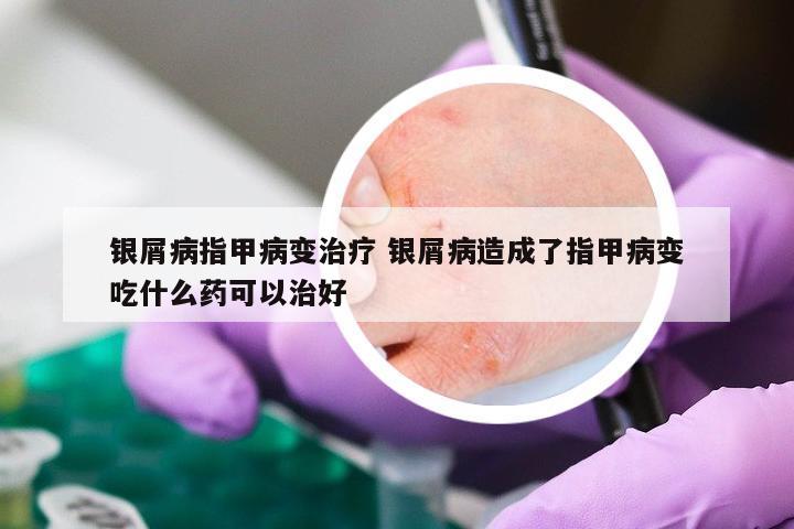 银屑病指甲病变治疗 银屑病造成了指甲病变吃什么药可以治好