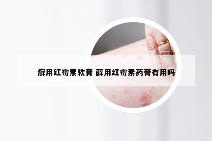 癣用红霉素软膏 藓用红霉素药膏有用吗