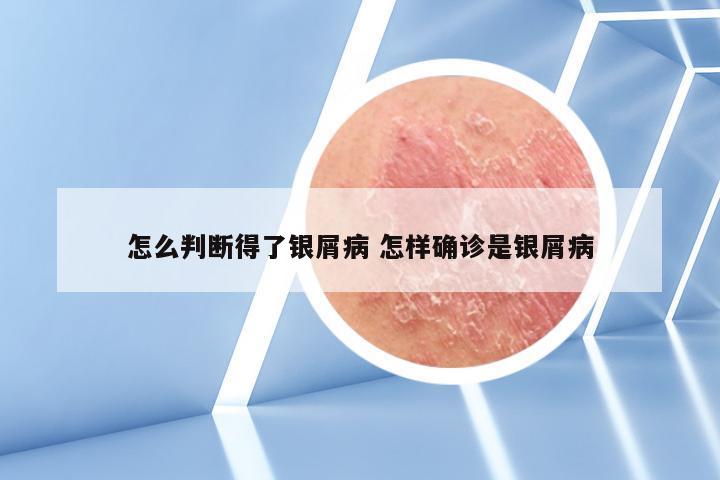 怎么判断得了银屑病 怎样确诊是银屑病