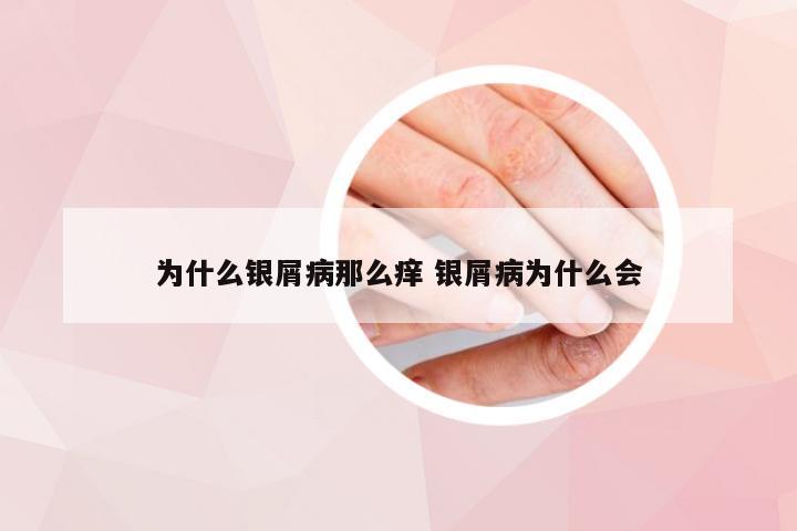 为什么银屑病那么痒 银屑病为什么会