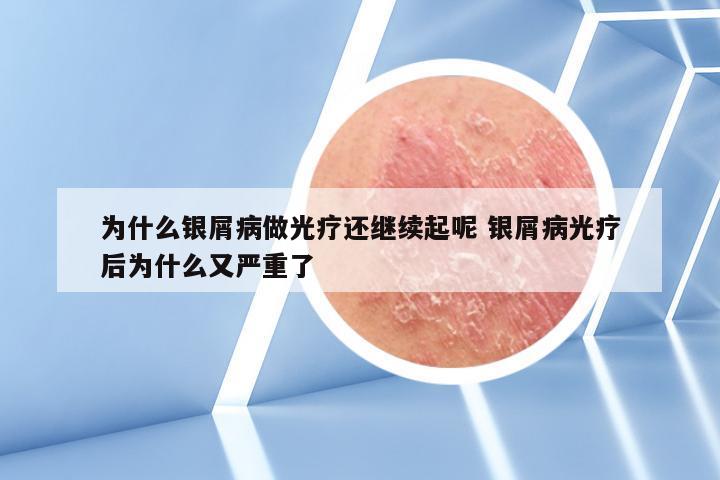 为什么银屑病做光疗还继续起呢 银屑病光疗后为什么又严重了