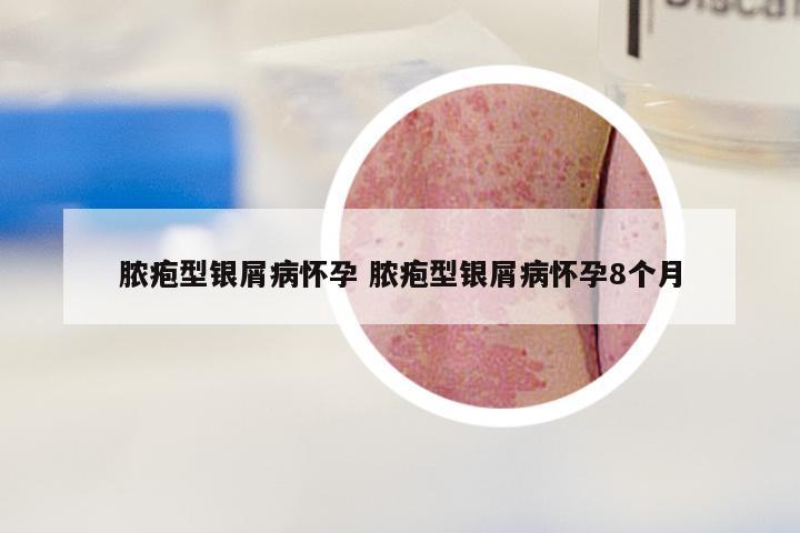 脓疱型银屑病怀孕 脓疱型银屑病怀孕8个月