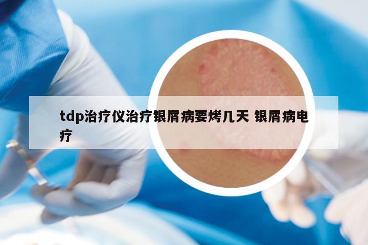 tdp治疗仪治疗银屑病要烤几天 银屑病电疗