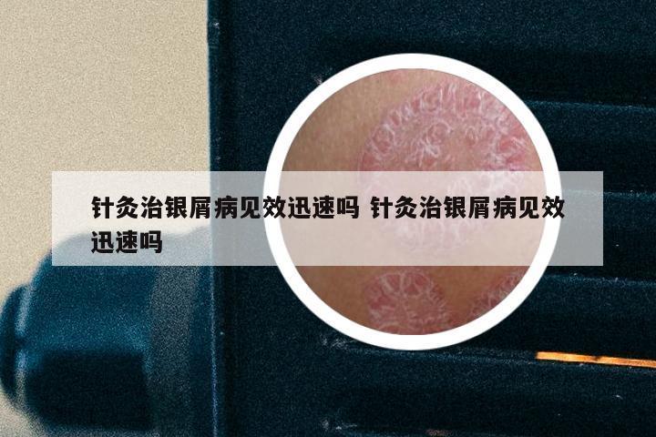 针灸治银屑病见效迅速吗 针灸治银屑病见效迅速吗