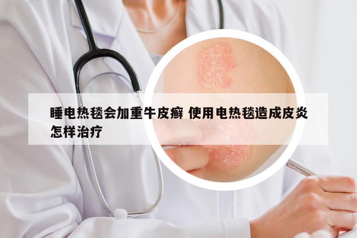 睡电热毯会加重牛皮癣 使用电热毯造成皮炎怎样治疗