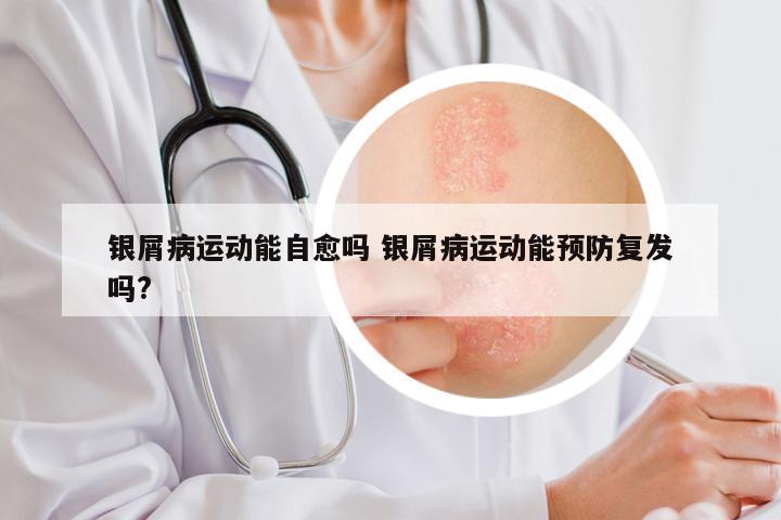 银屑病运动能自愈吗 银屑病运动能预防复发吗?