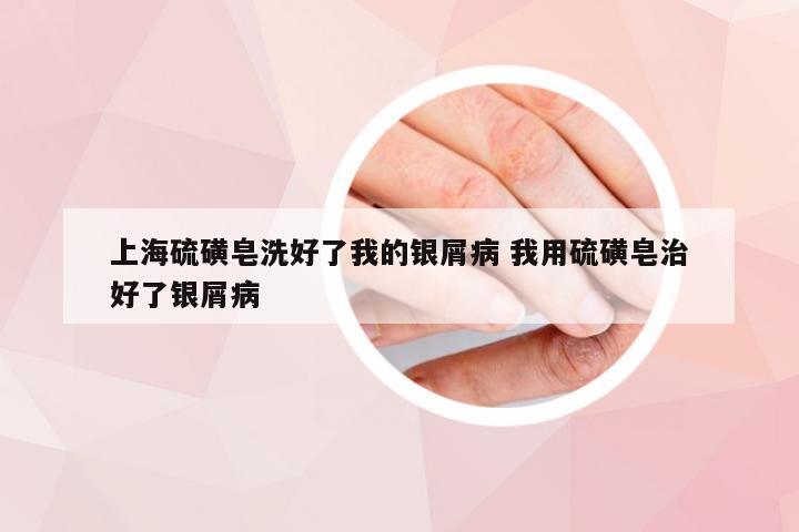 上海硫磺皂洗好了我的银屑病 我用硫磺皂治好了银屑病