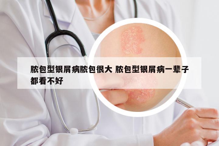 脓包型银屑病脓包很大 脓包型银屑病一辈子都看不好