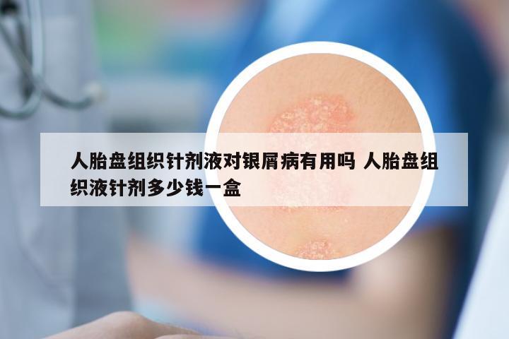 人胎盘组织针剂液对银屑病有用吗 人胎盘组织液针剂多少钱一盒