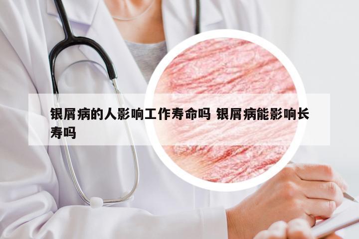 银屑病的人影响工作寿命吗 银屑病能影响长寿吗