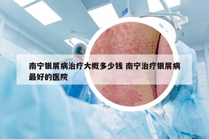 南宁银屑病治疗大概多少钱 南宁治疗银屑病最好的医院