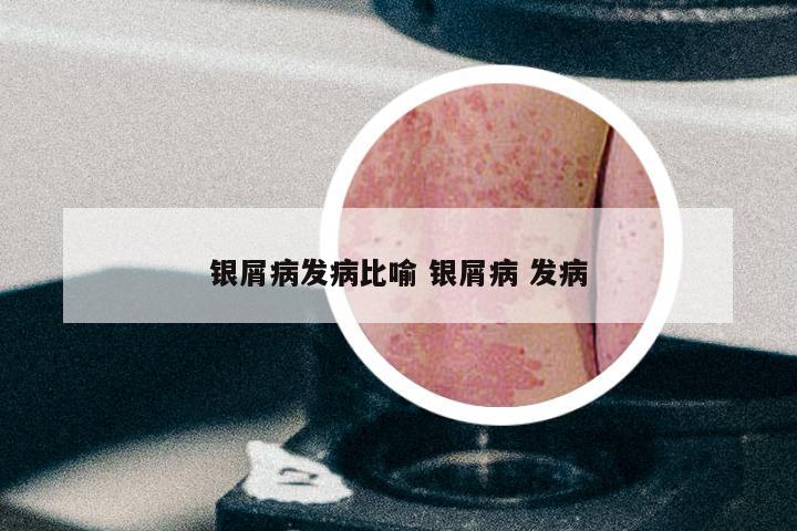 银屑病发病比喻 银屑病 发病