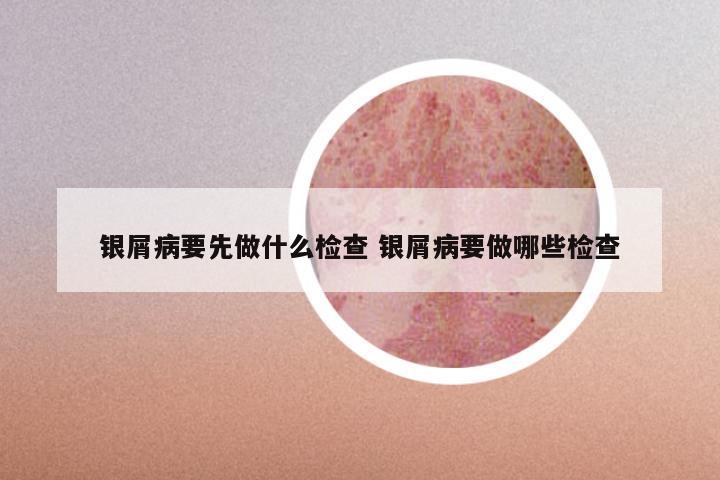 银屑病要先做什么检查 银屑病要做哪些检查