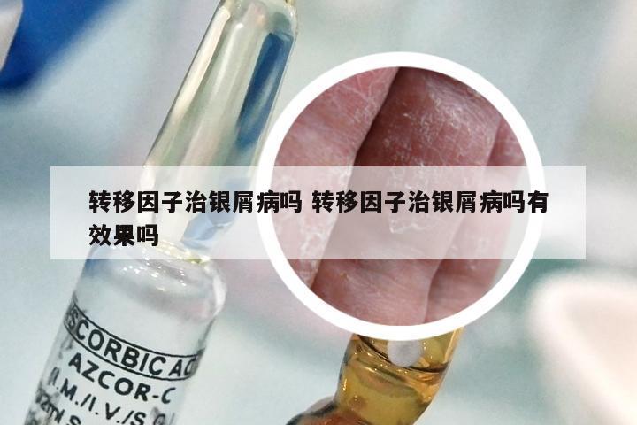 转移因子治银屑病吗 转移因子治银屑病吗有效果吗