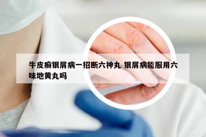 牛皮癣银屑病一招断六神丸 银屑病能服用六味地黄丸吗