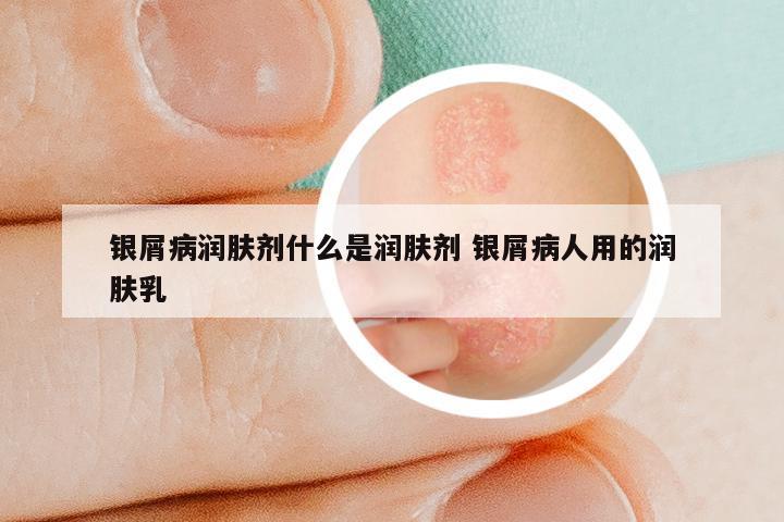 银屑病润肤剂什么是润肤剂 银屑病人用的润肤乳