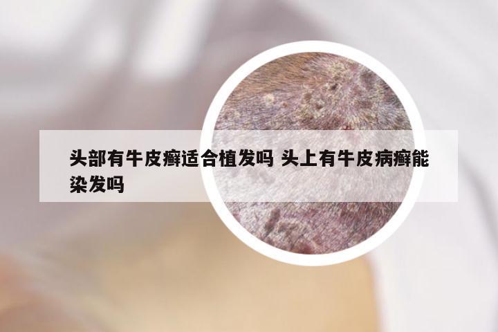 头部有牛皮癣适合植发吗 头上有牛皮病癣能染发吗