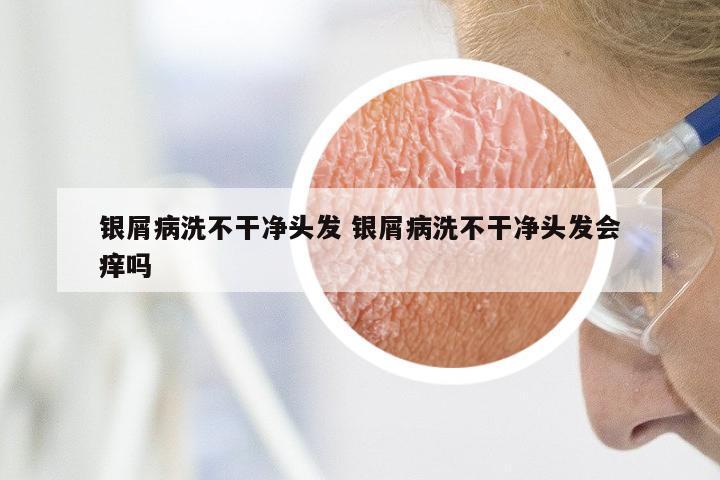 银屑病洗不干净头发 银屑病洗不干净头发会痒吗