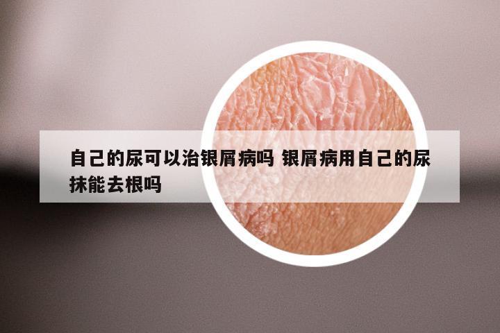 自己的尿可以治银屑病吗 银屑病用自己的尿抹能去根吗