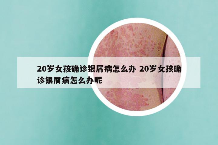 20岁女孩确诊银屑病怎么办 20岁女孩确诊银屑病怎么办呢