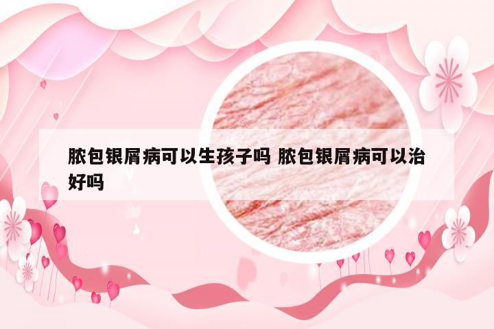 脓包银屑病可以生孩子吗 脓包银屑病可以治好吗