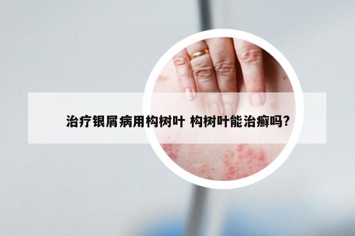 治疗银屑病用构树叶 构树叶能治癣吗?