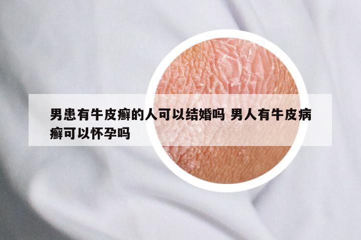 男患有牛皮癣的人可以结婚吗 男人有牛皮病癣可以怀孕吗