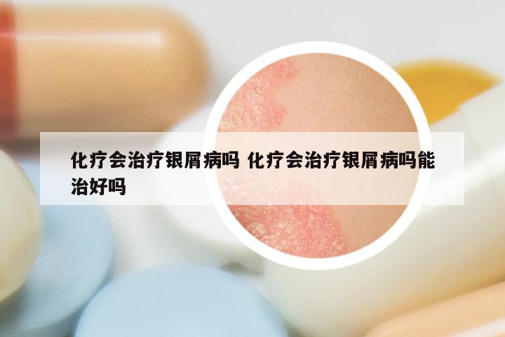 化疗会治疗银屑病吗 化疗会治疗银屑病吗能治好吗