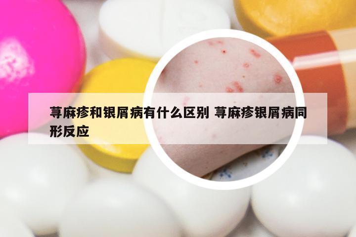 荨麻疹和银屑病有什么区别 荨麻疹银屑病同形反应