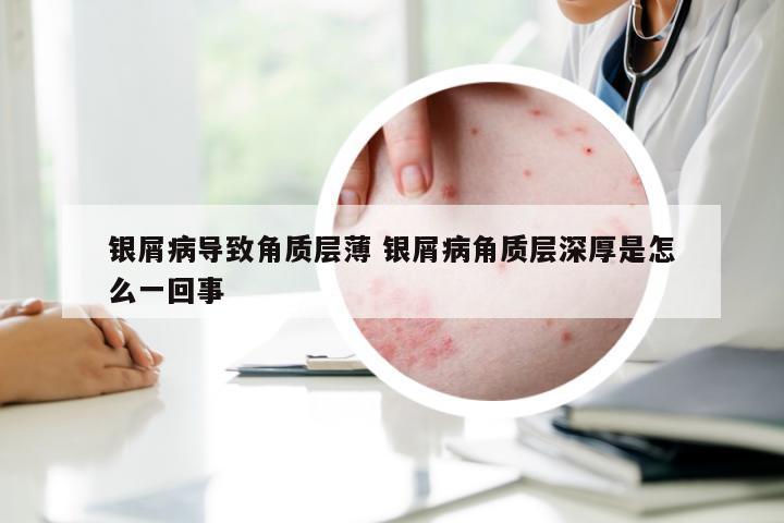 银屑病导致角质层薄 银屑病角质层深厚是怎么一回事