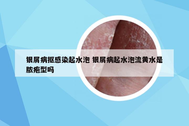 银屑病抠感染起水泡 银屑病起水泡流黄水是脓疱型吗