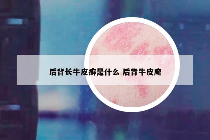 后背长牛皮癣是什么 后背牛皮廨