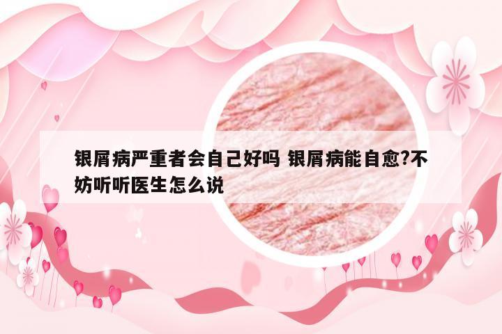 银屑病严重者会自己好吗 银屑病能自愈?不妨听听医生怎么说