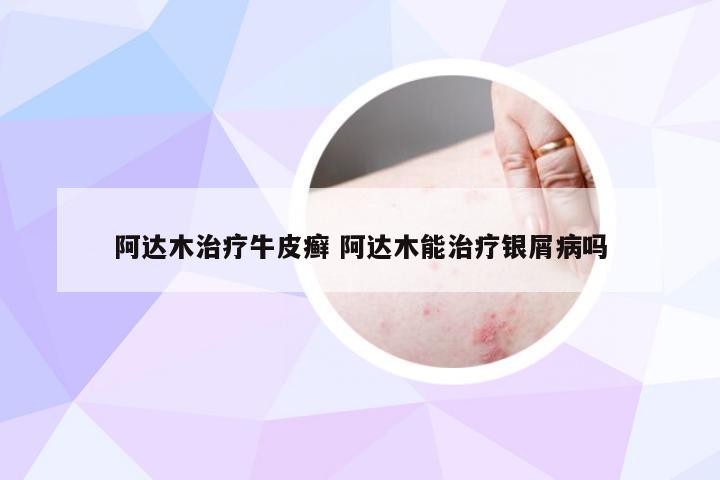 阿达木治疗牛皮癣 阿达木能治疗银屑病吗