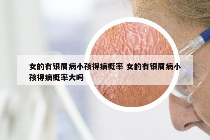 女的有银屑病小孩得病概率 女的有银屑病小孩得病概率大吗