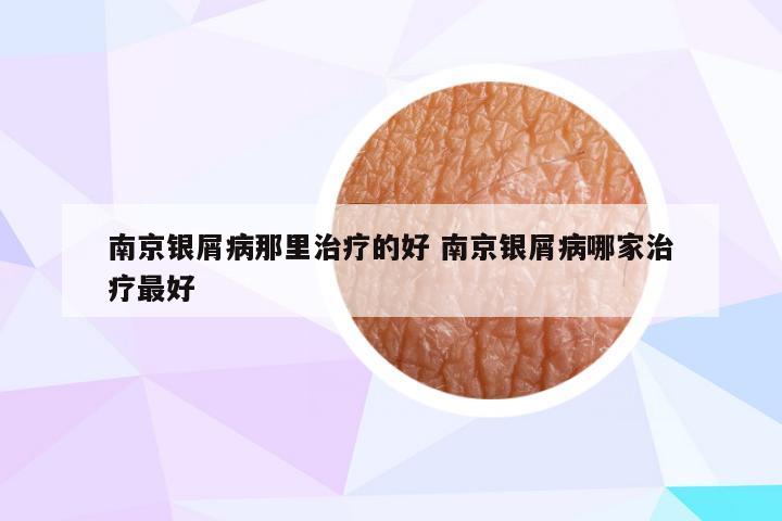 南京银屑病那里治疗的好 南京银屑病哪家治疗最好