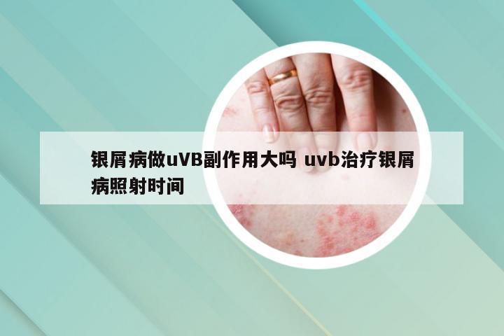 银屑病做uVB副作用大吗 uvb治疗银屑病照射时间